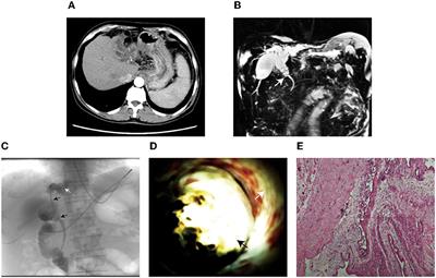 Case report: Single-operator peroral cholangioscopy system (SpyGlass) diagnosis of an extrahepatic biliary cystadenoma (video)